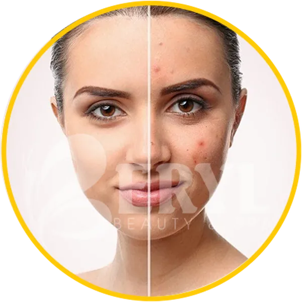 Giải Đáp Những Cách Trị Thâm Mụn & Trị Sẹo Mụn Hiệu Quả