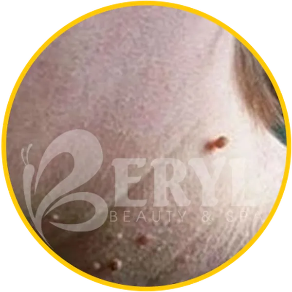 Chi Phí Trị Mụn Thịt – Giá Trị Mụn Bao Nhiêu Tiền?