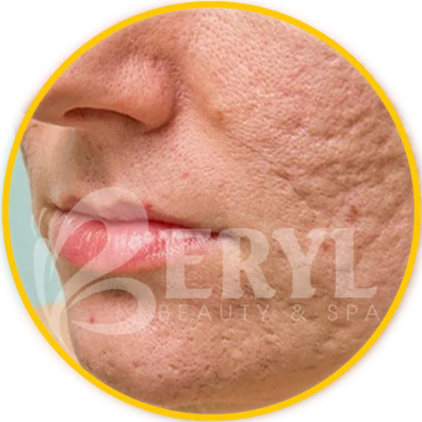 Sẹo Rỗ Có Trị Được Không?