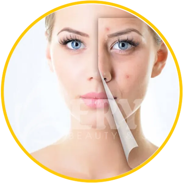 Spa Trị Mụn Hiệu Quả Và Uy Tín Tại Quận Bình Thạnh TPHCM