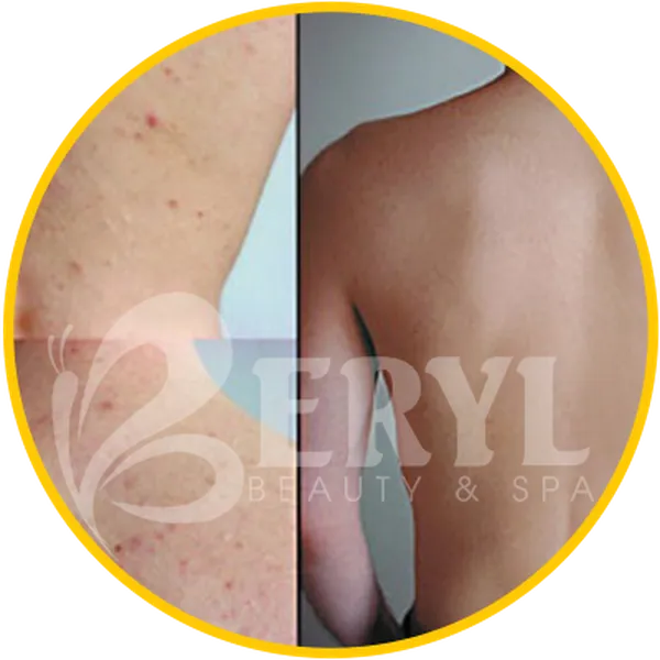 Trị Mụn Lưng Cho Nam - Spa Trị Mụn Ở Lưng Cho Nam Giới Tại TPHCM