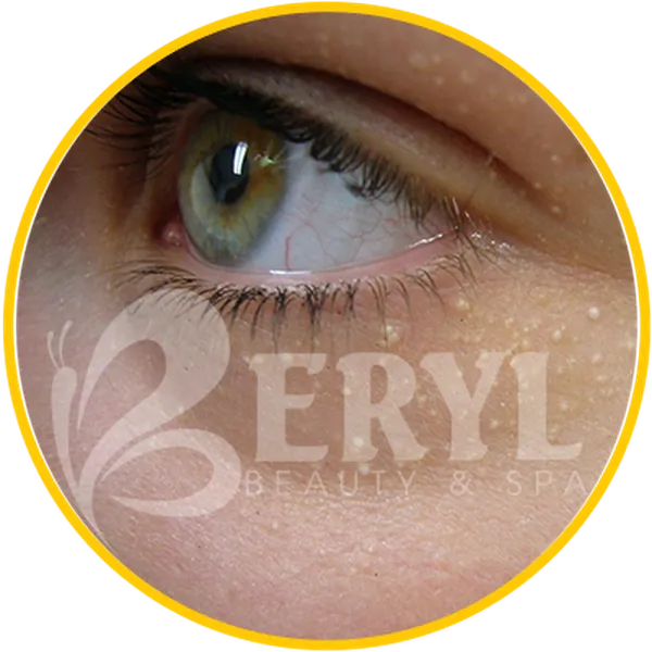 Spa Trị Mụn Thịt Quanh Mắt An Toàn Và Hiệu Quả Tại TPHCM