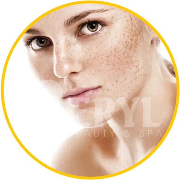 Spa Trị Tàn Nhang Hiệu Quả Và Uy Tín Tại TPHCM