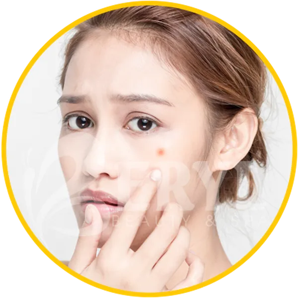 Làm Sao Để Trị Hết Mụn Ở Tuổi Dậy Thì?