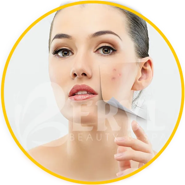 Trị Sẹo Rỗ Ở Đâu Hiệu Quả?