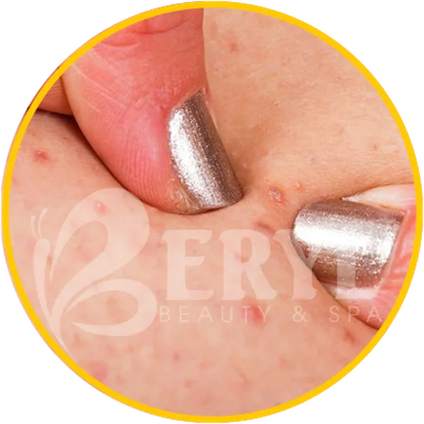 Viêm Nang Lông Ở Mặt Là Gì?