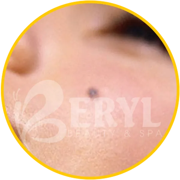 Xóa Nốt Ruồi Bao Nhiêu Tiền – Xóa Nốt Ruồi Bằng Laser Giá Bao Nhiêu?