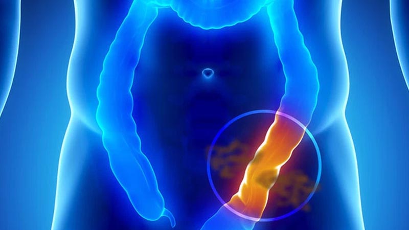 Hội chứng rò rỉ ruột là gì Hội chứng rò rỉ ruột là gì