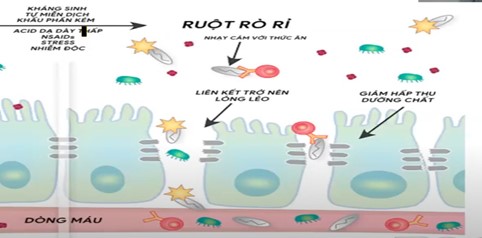 Ruột rò rỉ Ruột rò rỉ