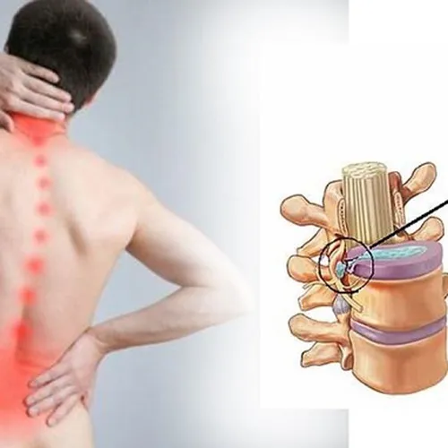 Điều Trị Thoát Vị Đĩa Đệm ở Bắc Tân Uyên