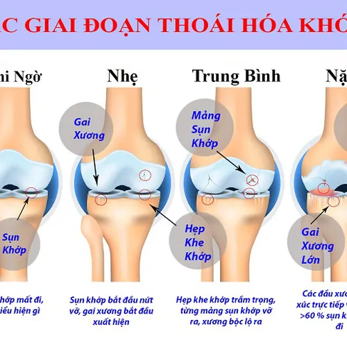 Điều Trị Thoái Hóa Khớp tại Thủ Dầu Một