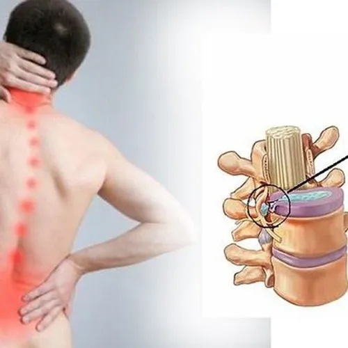 Điều Trị Thoát Vị Đĩa Đệm ở Bàu Bàng
