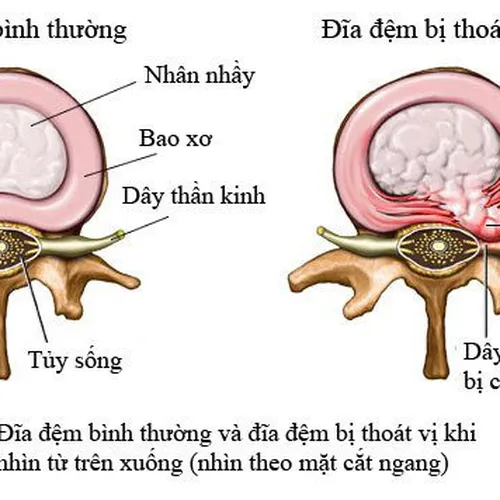 Điều Trị Thoát Vị Đĩa Đệm ở Dầu Tiếng