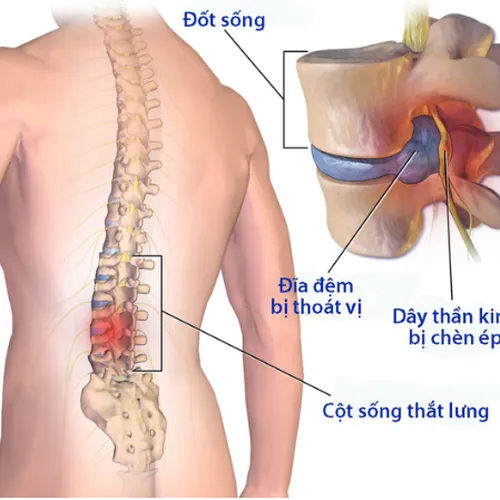 Điều Trị Thoát Vị Đĩa Đệm ở Hà Nội