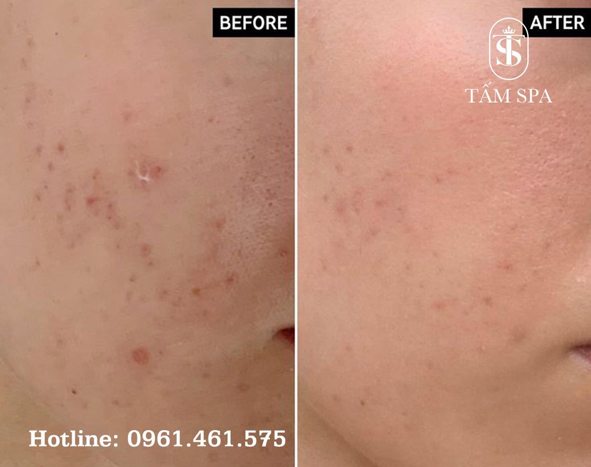 Lấy Nhân Mụn Chuẩn Y Khoa Cơ Bản Bí Quyết Chăm Sóc Da Hiệu Quả