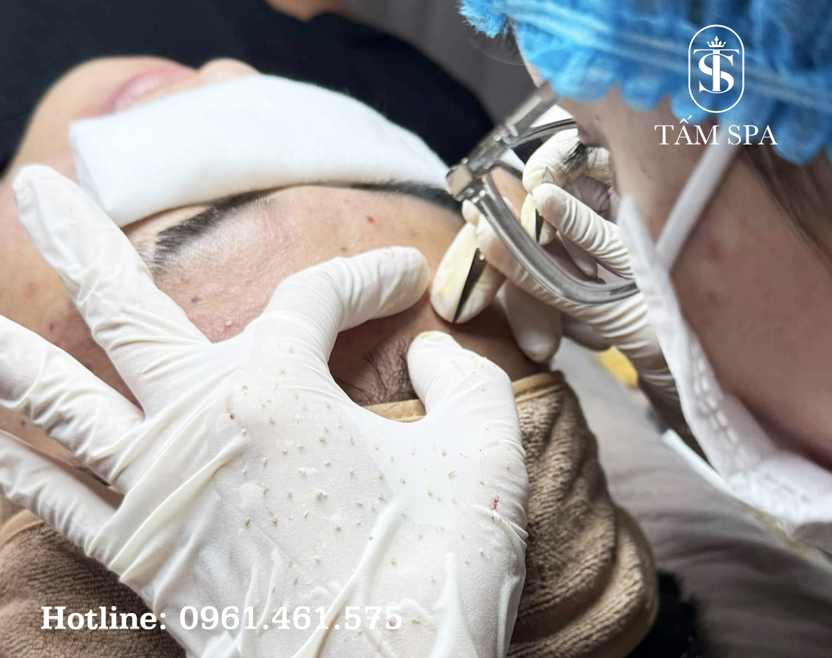 Lấy Nhân Mụn Chuẩn Y Khoa Cơ Bản Bí Quyết Chăm Sóc Da Hiệu Quả