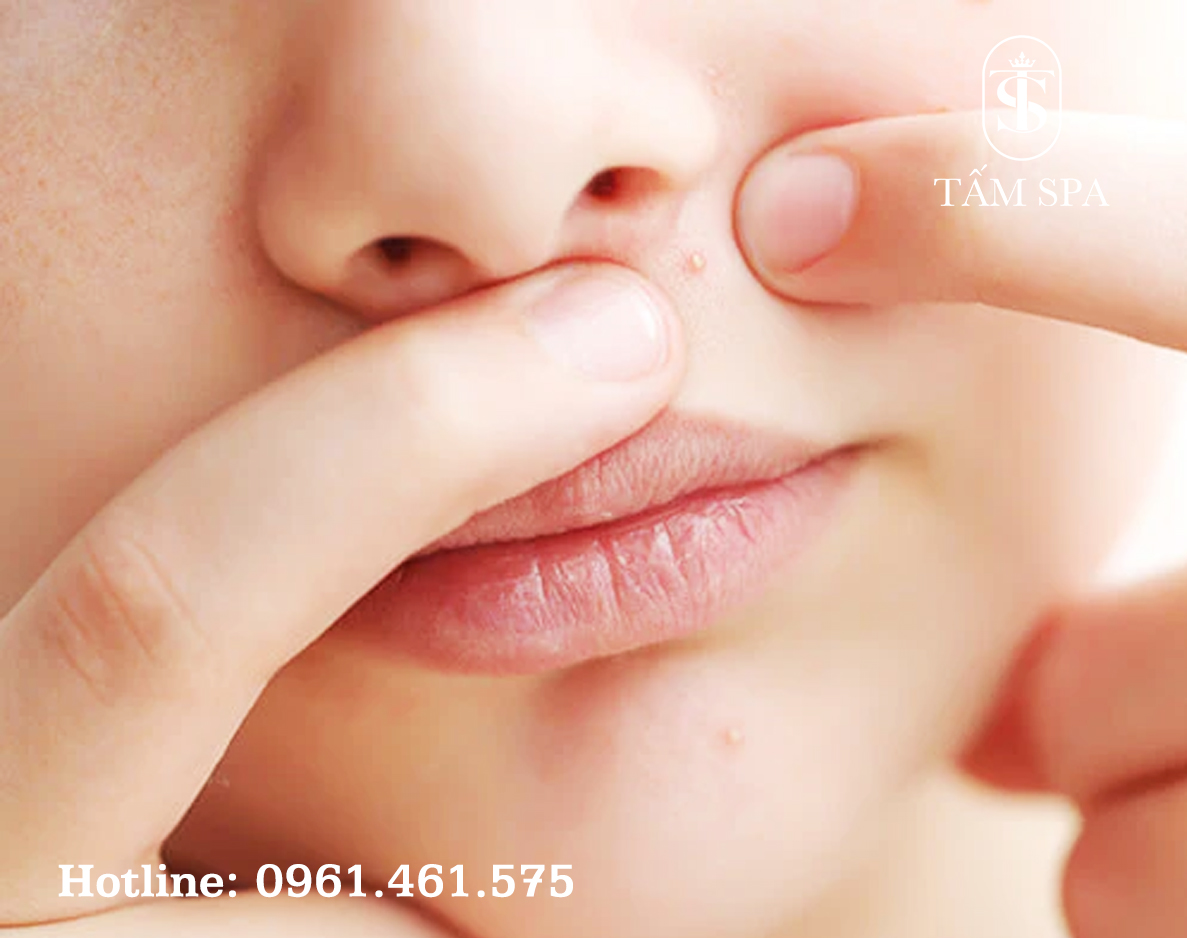 Lấy Nhân Mụn Chuẩn Y Khoa Cơ Bản Bí Quyết Chăm Sóc Da Hiệu Quả