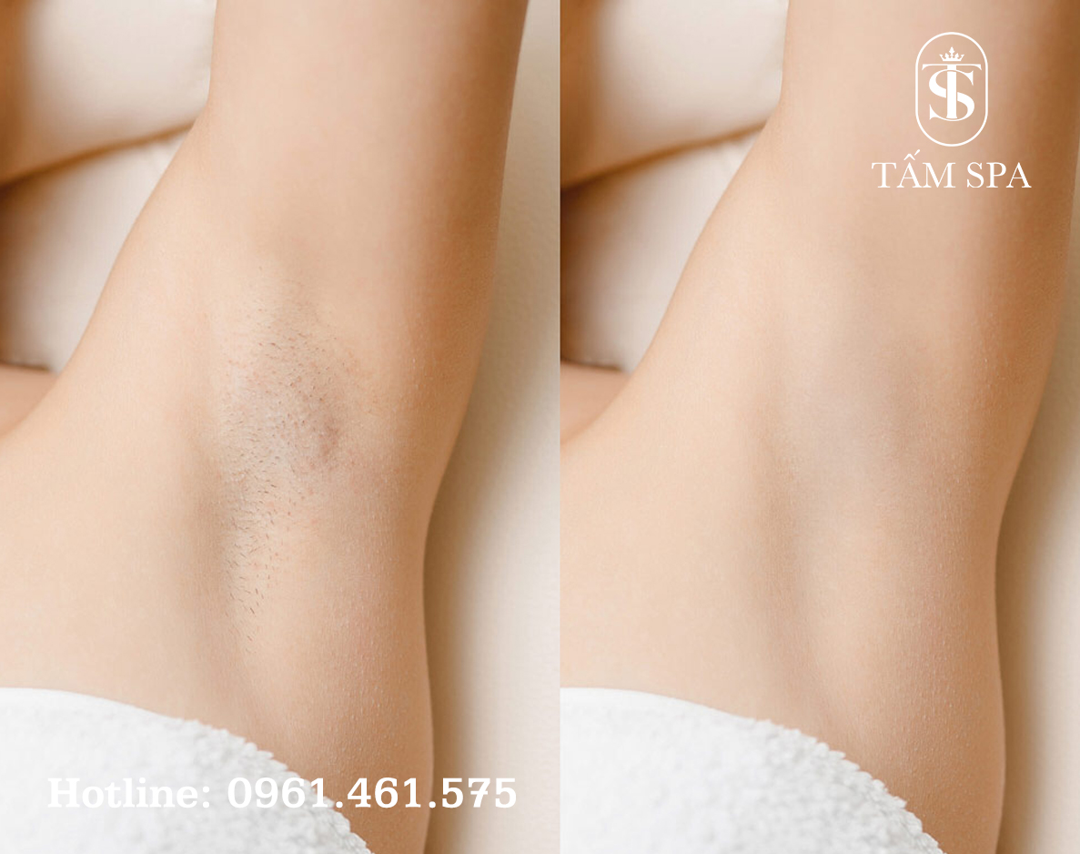Dịch Vụ Triệt Lông Tại Tấm Spa Dịch Vụ Triệt Lông Tại Tấm Spa