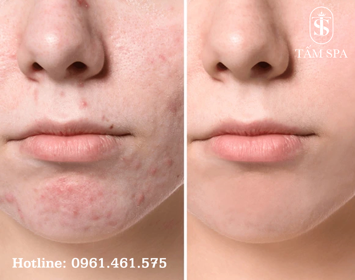 Dịch Vụ Lấy Nhân Mụn Chuẩn Y Khoa Chuyên Sâu Tại Tấm Spa Dịch Vụ Lấy Nhân Mụn Chuẩn Y Khoa Chuyên Sâu Tại Tấm Spa