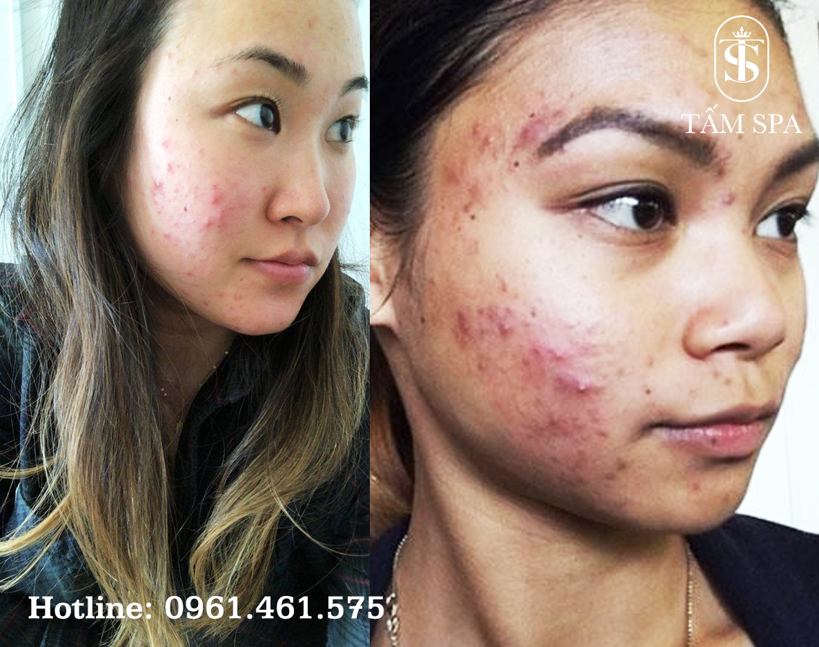 Dịch Vụ Lấy Nhân Mụn Chuẩn Y Khoa Chuyên Sâu Tại Tấm Spa Dịch Vụ Lấy Nhân Mụn Chuẩn Y Khoa Chuyên Sâu Tại Tấm Spa