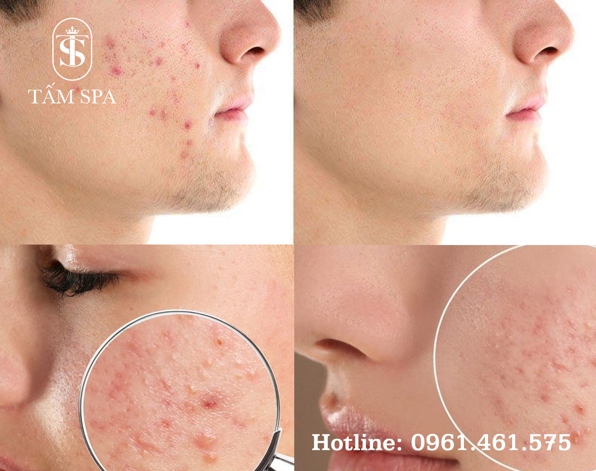 Dịch Vụ Lấy Nhân Mụn Chuẩn Y Khoa Chuyên Sâu Tại Tấm Spa Dịch Vụ Lấy Nhân Mụn Chuẩn Y Khoa Chuyên Sâu Tại Tấm Spa