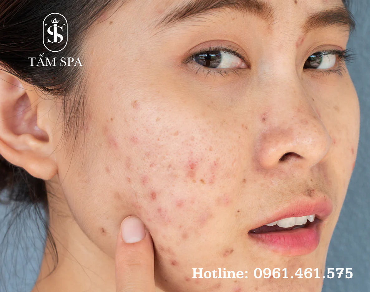 Dịch Vụ Lấy Nhân Mụn Chuẩn Y Khoa Cơ Bản Tại Tấm Spa Dịch Vụ Lấy Nhân Mụn Chuẩn Y Khoa Cơ Bản Tại Tấm Spa