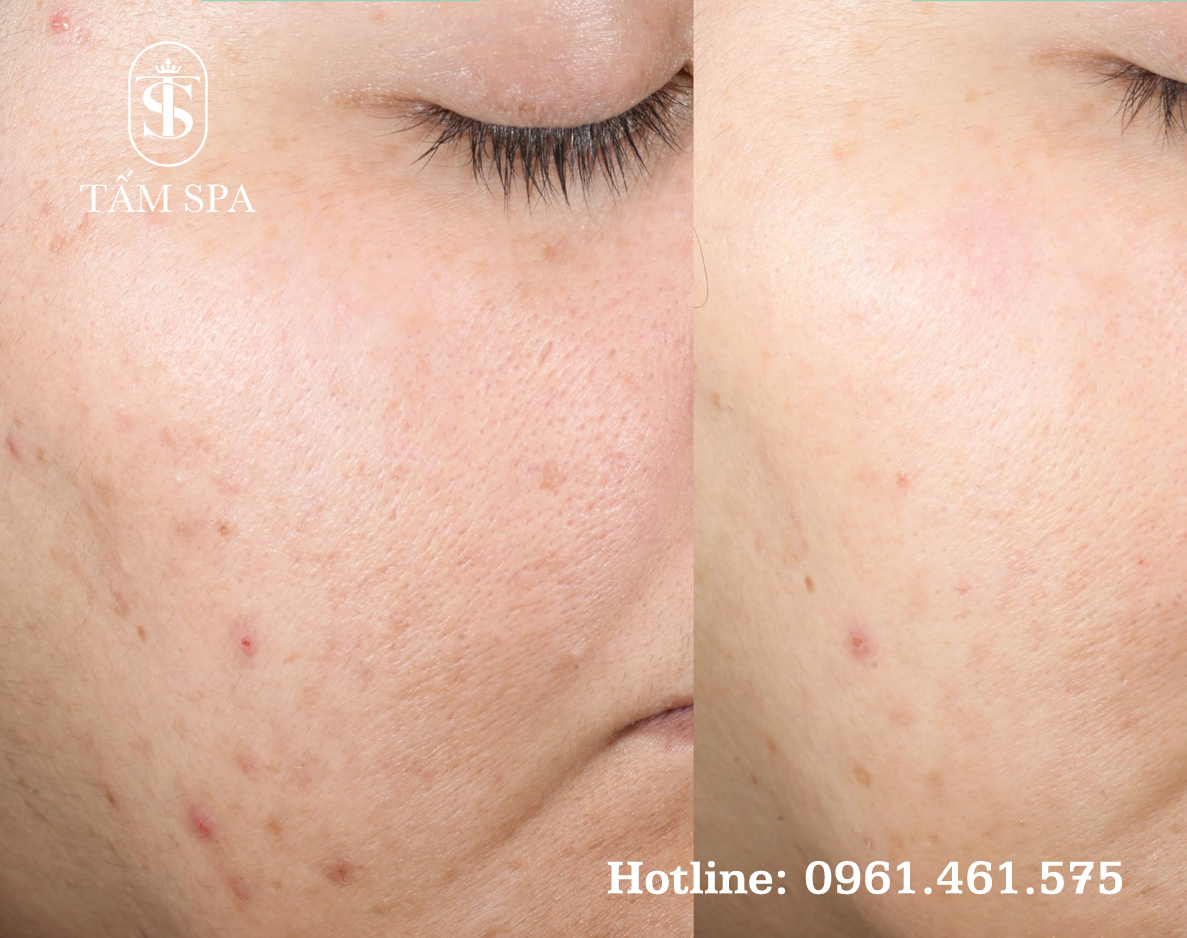 Dịch Vụ Lấy Nhân Mụn Chuẩn Y Khoa Cơ Bản Tại Tấm Spa Dịch Vụ Lấy Nhân Mụn Chuẩn Y Khoa Cơ Bản Tại Tấm Spa