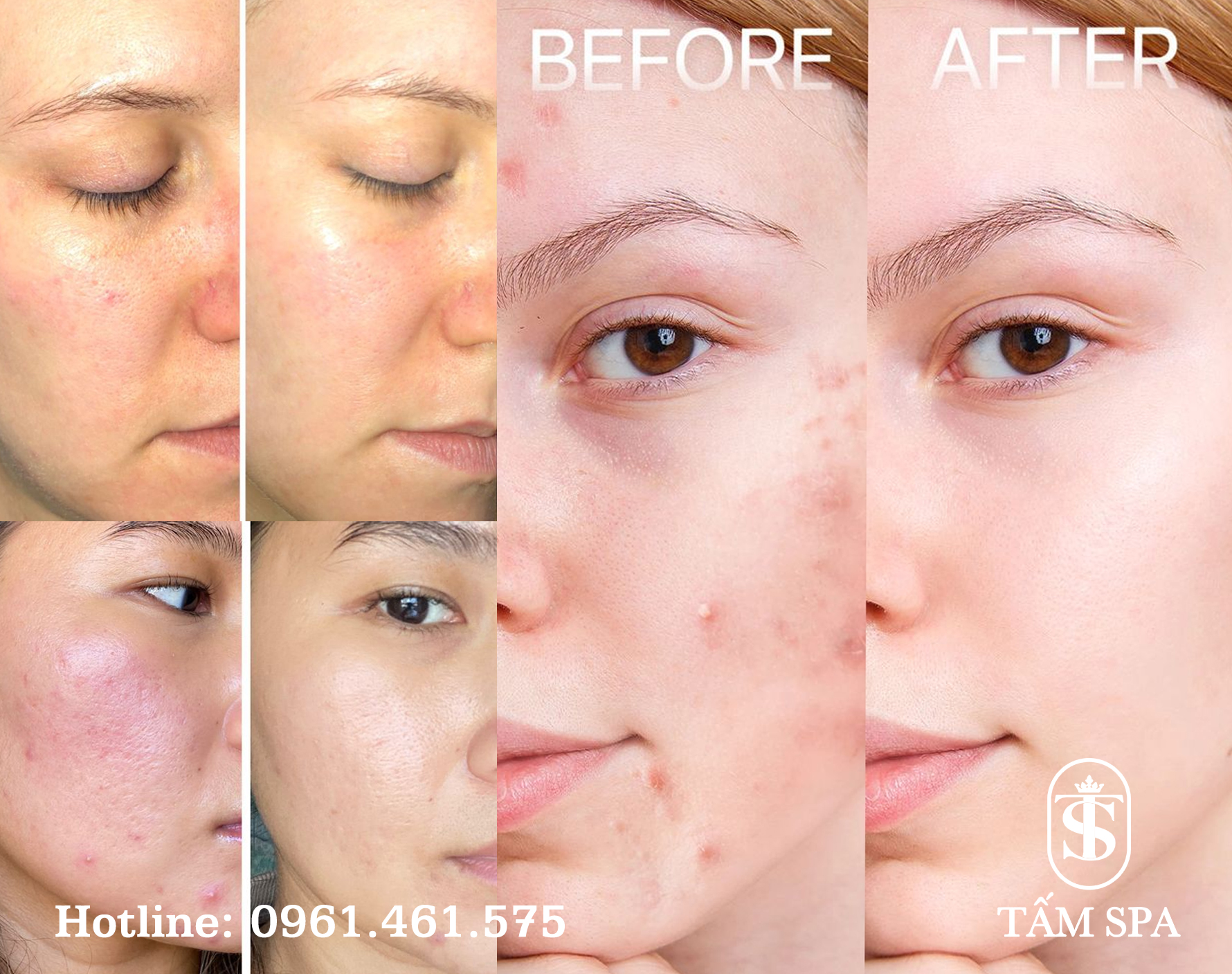 Lấy Mụn Chuẩn Y Khoa Chuyên Sâu Giải Pháp Tối Ưu Cho Làn Da Khỏe Mạnh Lấy Mụn Chuẩn Y Khoa Chuyên Sâu Giải Pháp Tối Ưu Cho Làn Da Khỏe Mạnh