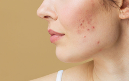 Sạch Nhân Mụn, Sáng Da Mặt - Trải Nghiệm Dịch Vụ Chuẩn Y Khoa Ngay Hôm Nay Sạch Nhân Mụn, Sáng Da Mặt - Trải Nghiệm Dịch Vụ Chuẩn Y Khoa Ngay Hôm Nay