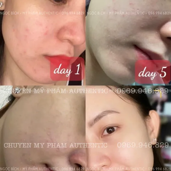 Kem Dưỡng Trắng Da Meiduzi, trị mụn ,mờ thâm nám hiệu quả