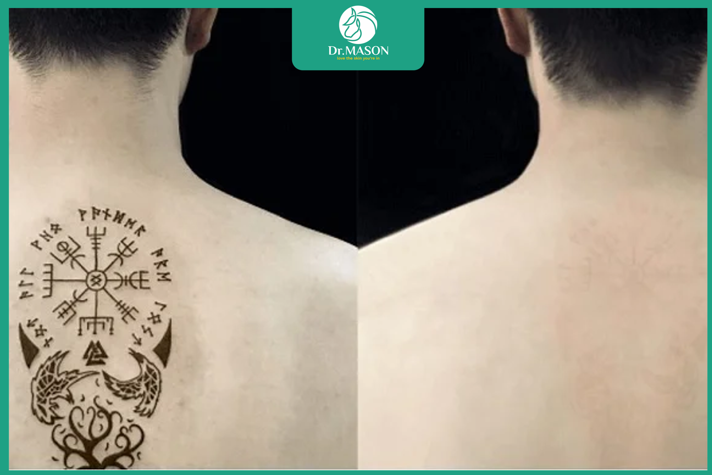 hình ảnh trước sau khi xóa xăm