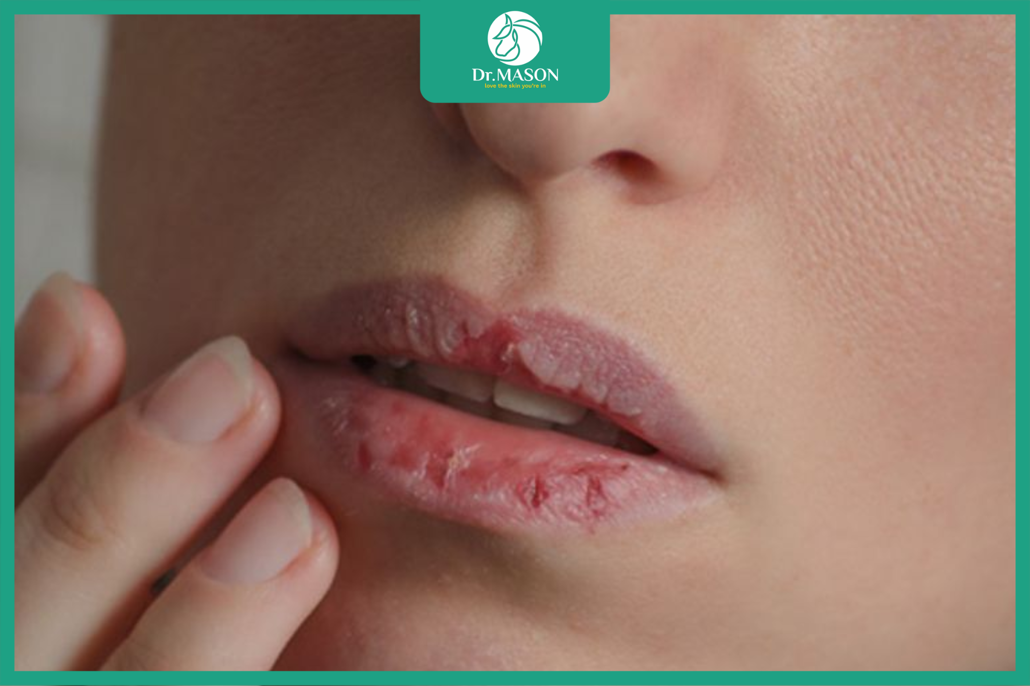 khô môi khi dùng isotretinoin