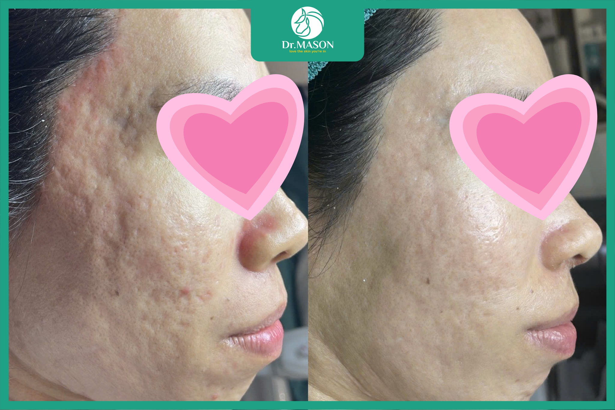 Review bóc tách sẹo sau 1 lần tại Dr Mã Sơn