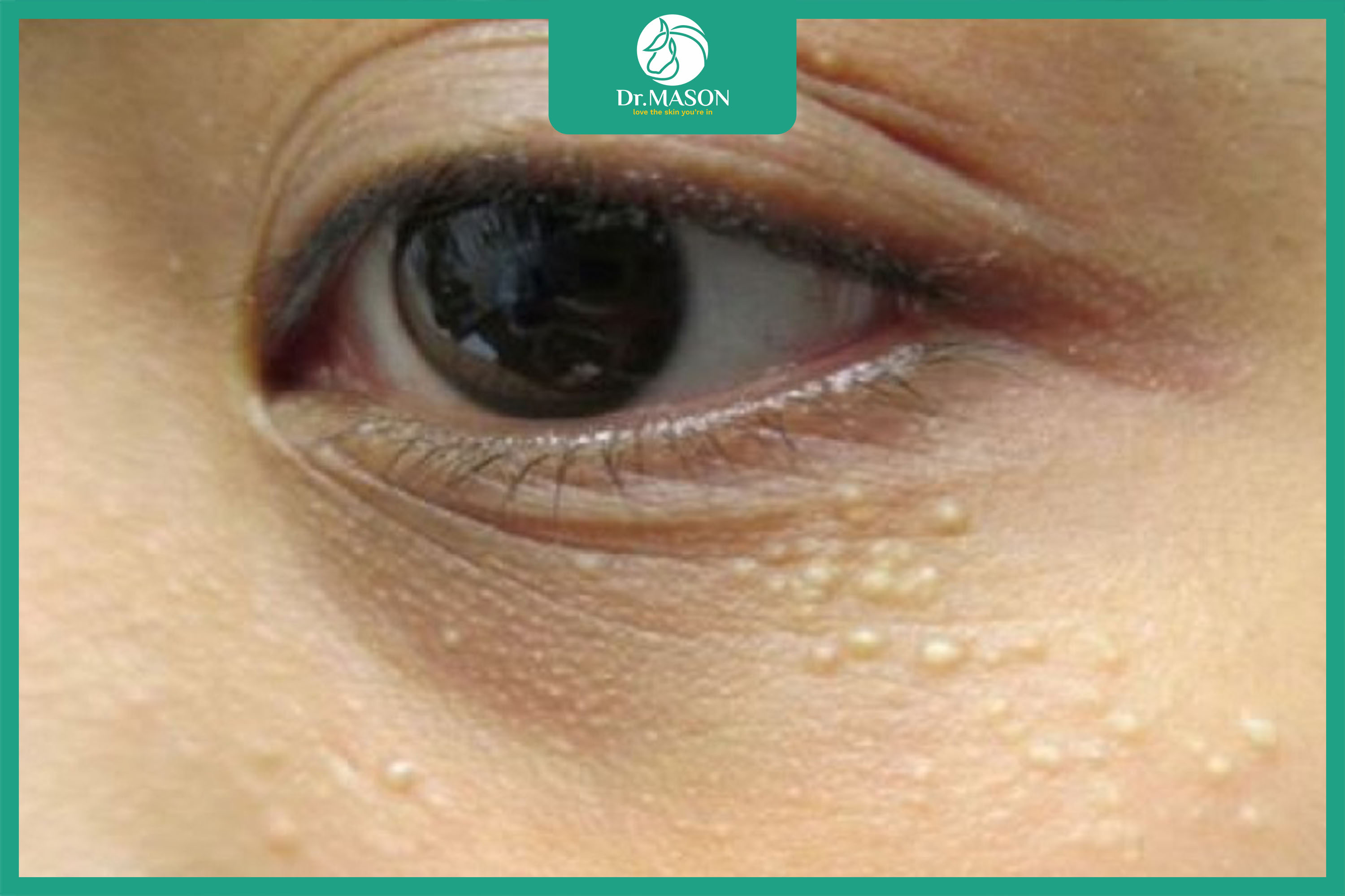 hình ảnh mụn thịt quanh mắt