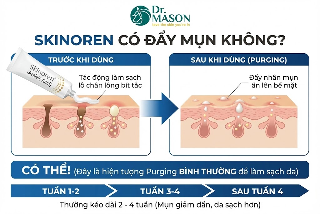 skinoren có đẩy mụn không