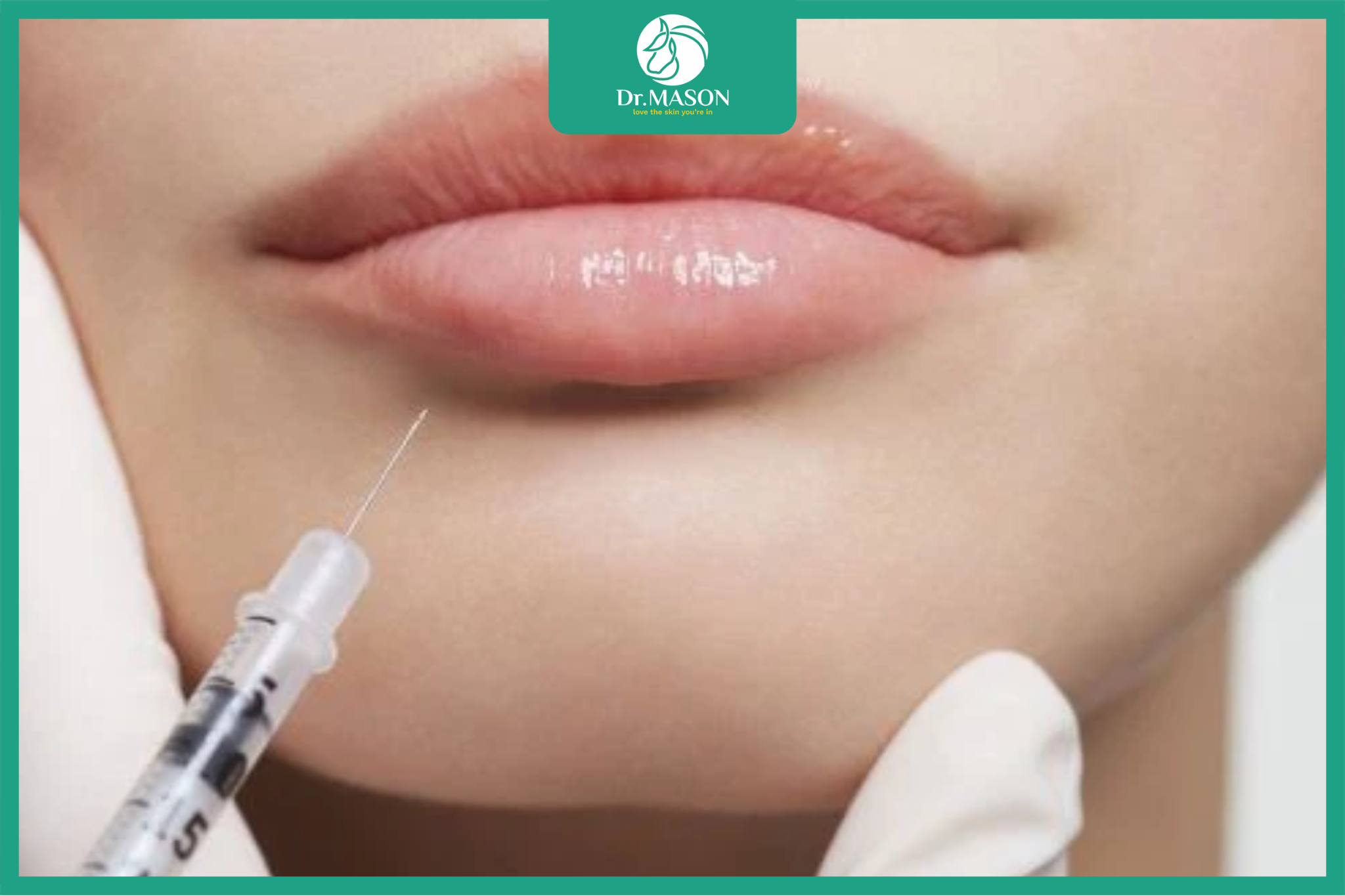 filler vùng môi
