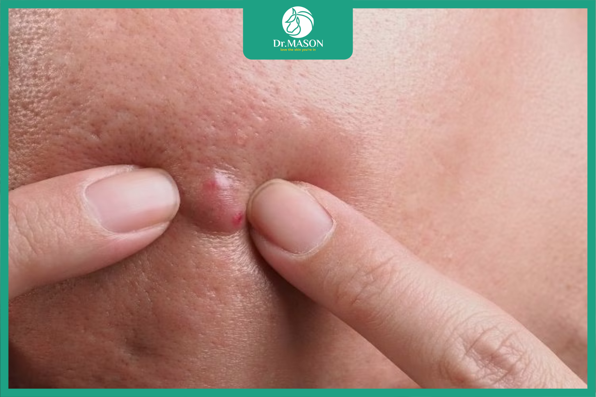 mụn chai cứng to