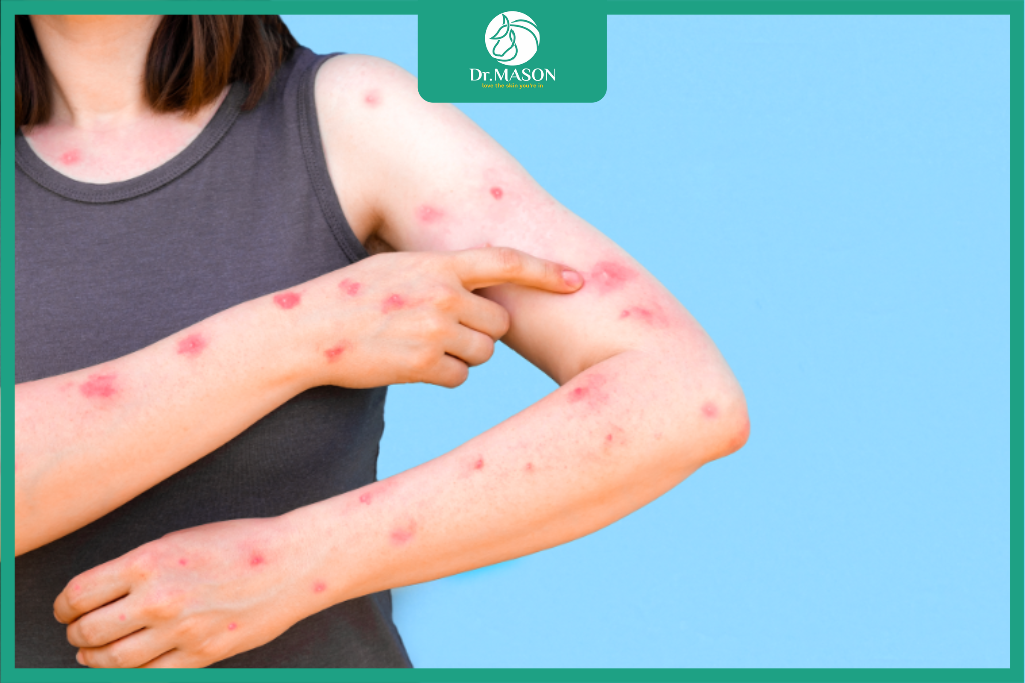 hình ảnh thủy đậu toàn thân