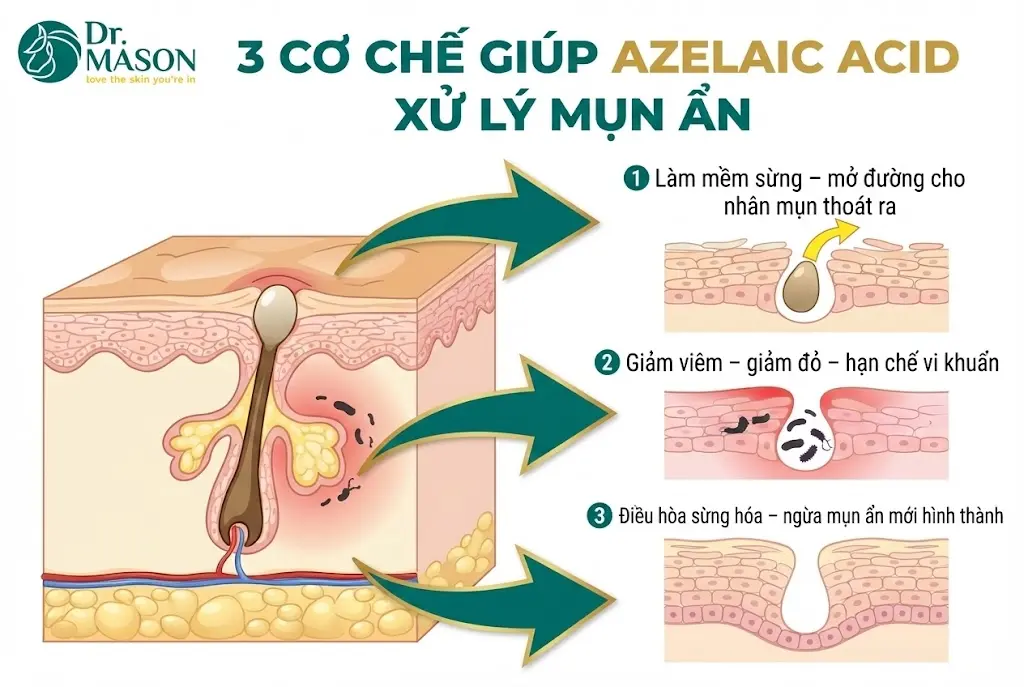 3 cơ chế giúp acid azelaic trị mụn ẩn