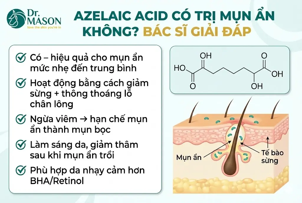 azelaic acid có trị mụn ẩn không