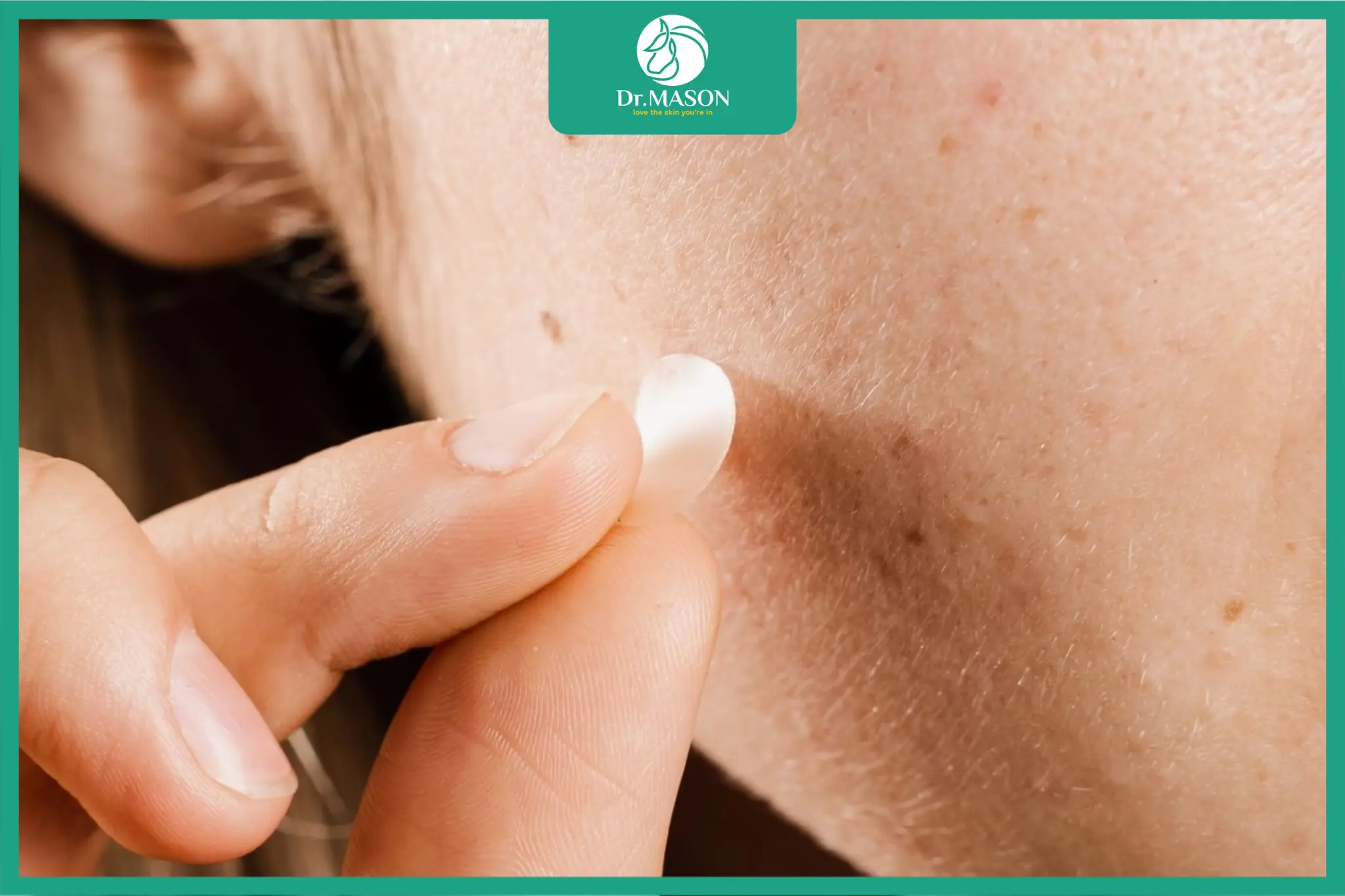 Bác sĩ da liễu tư vấn cho bệnh nhân về chỉ định và cách sử dụng miếng dán mụn microneedle an toàn