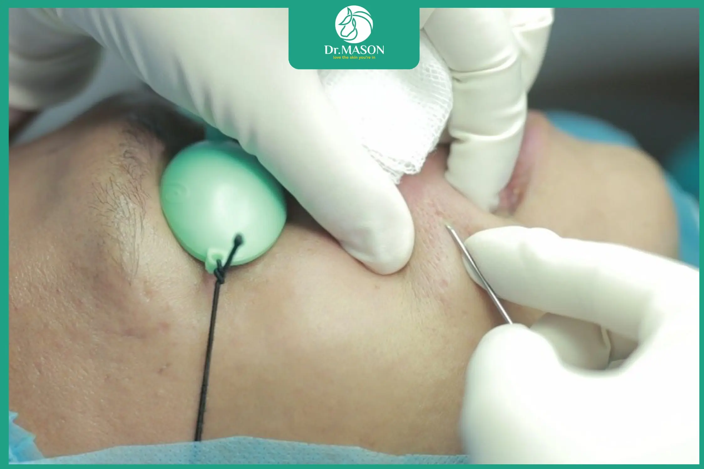 cận cảnh bác sĩ bóc tách sẹo