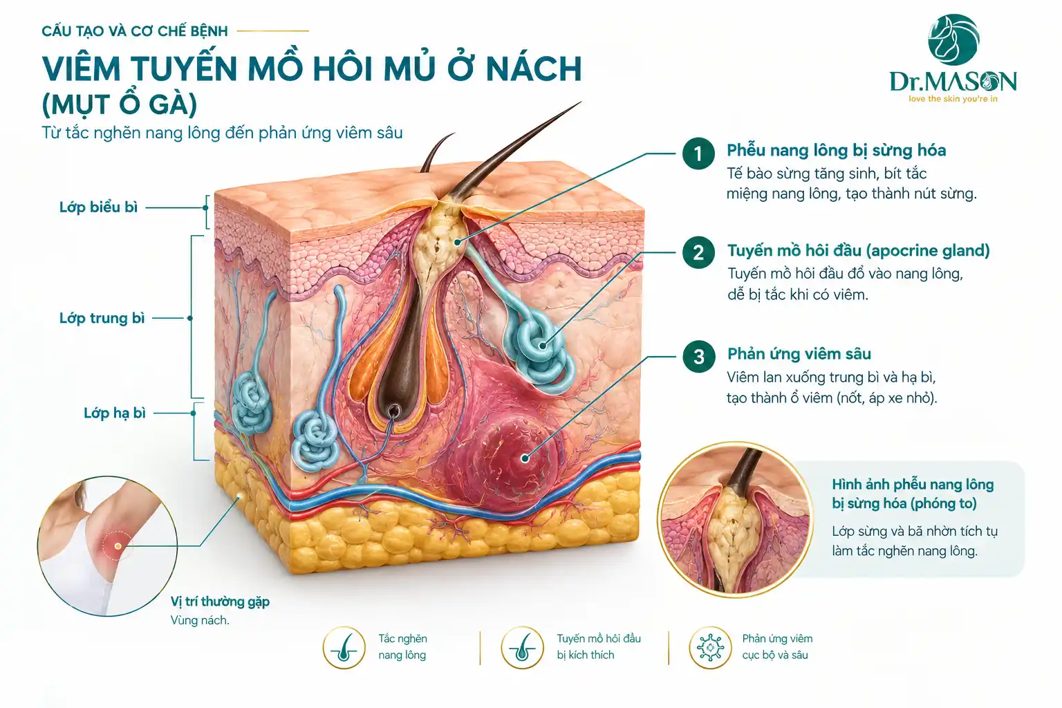 Cấu tạo bệnh học viêm tuyến mồ hôi mủ