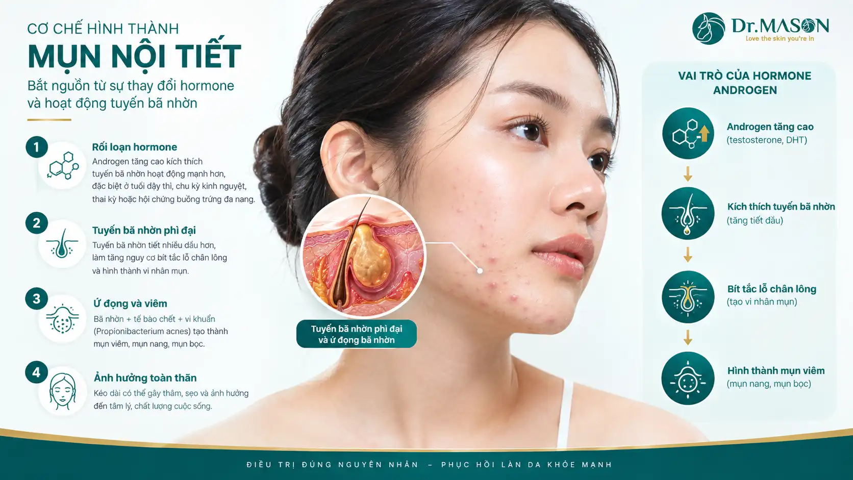 Phác đồ trị mụn nội tiết đa tầng tại Dr Mã Sơn Clinic