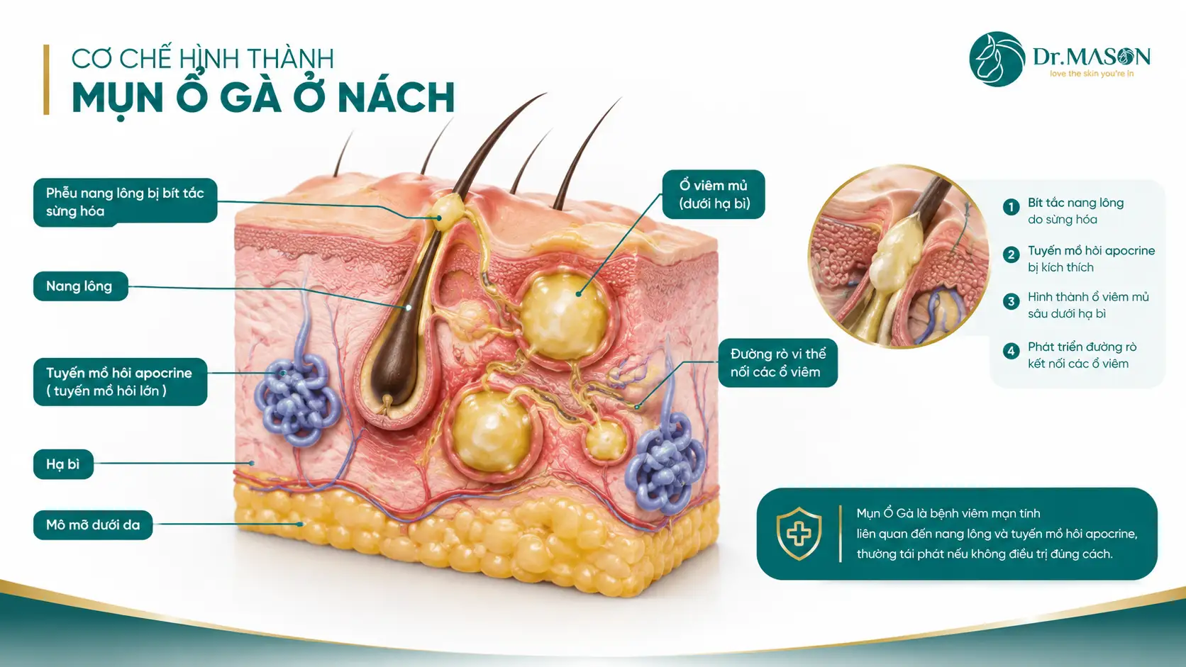 Cơ chế hình thành mụn ổ gà ở nách