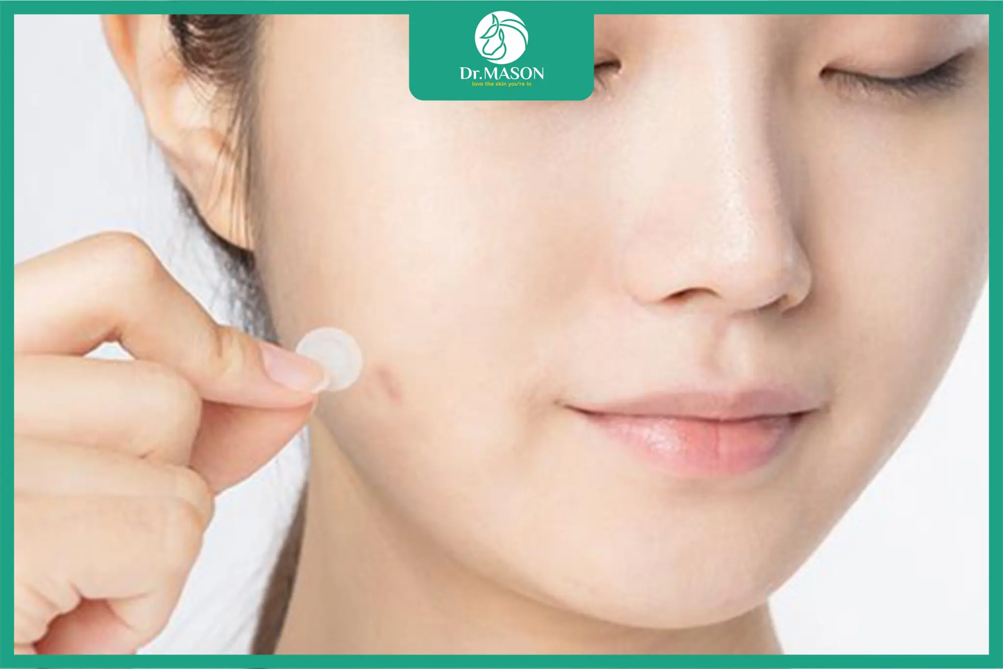 Sơ đồ minh họa vi kim microneedle xuyên qua lớp sừng và giải phóng hoạt chất điều trị mụn vào da