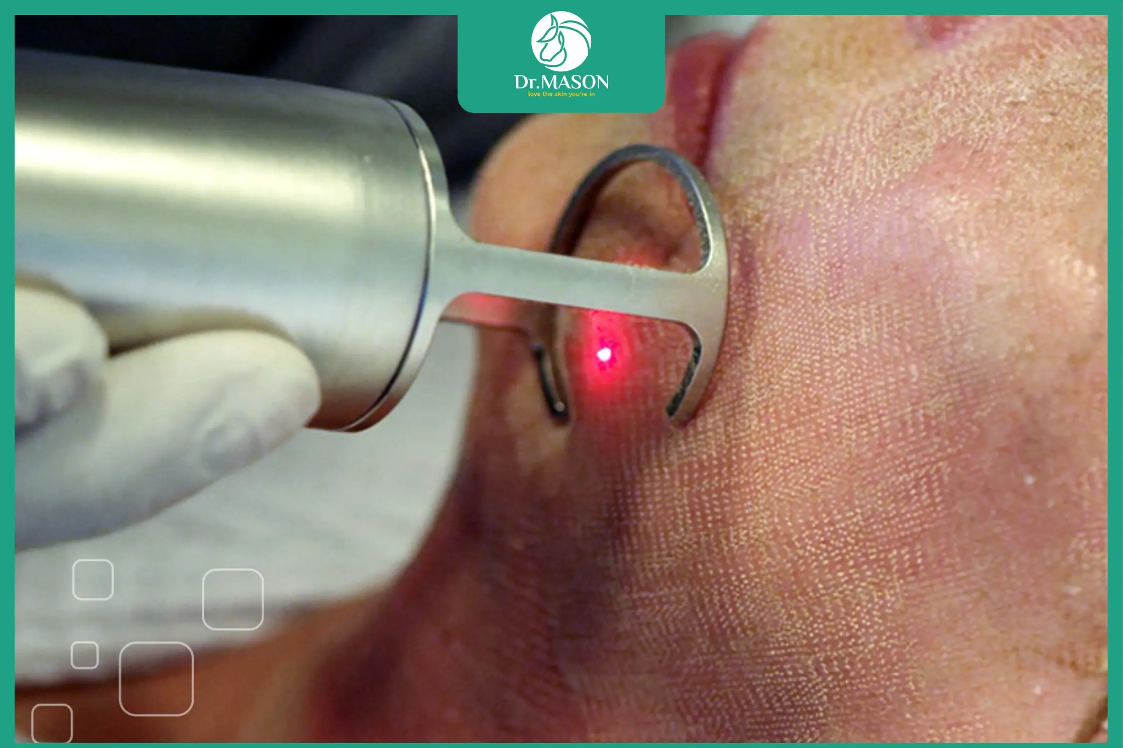 công nghệ fractional co2 điều trị sẹo rỗ