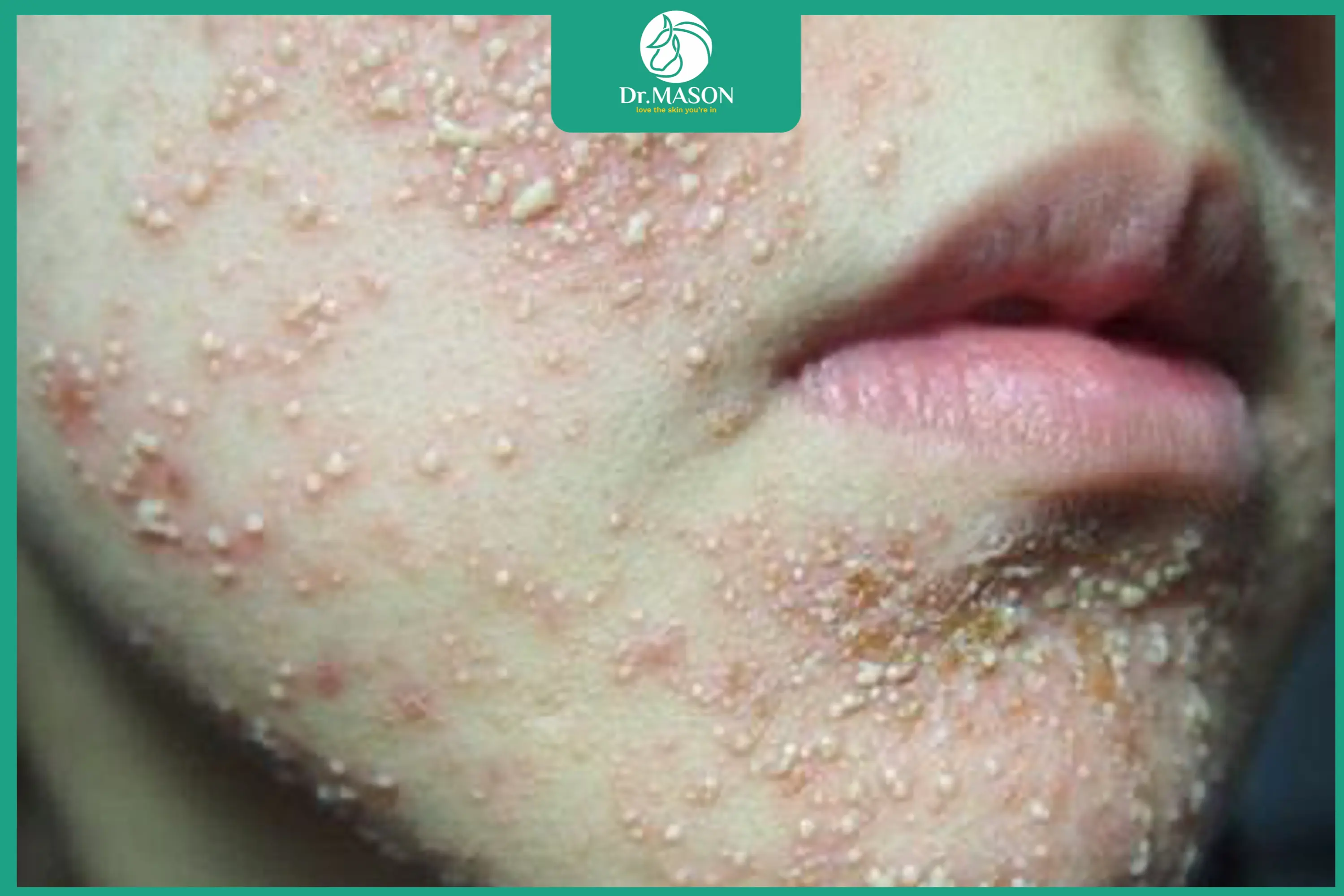 Da nhiễm corticoid là gì – biểu hiện và dấu hiệu