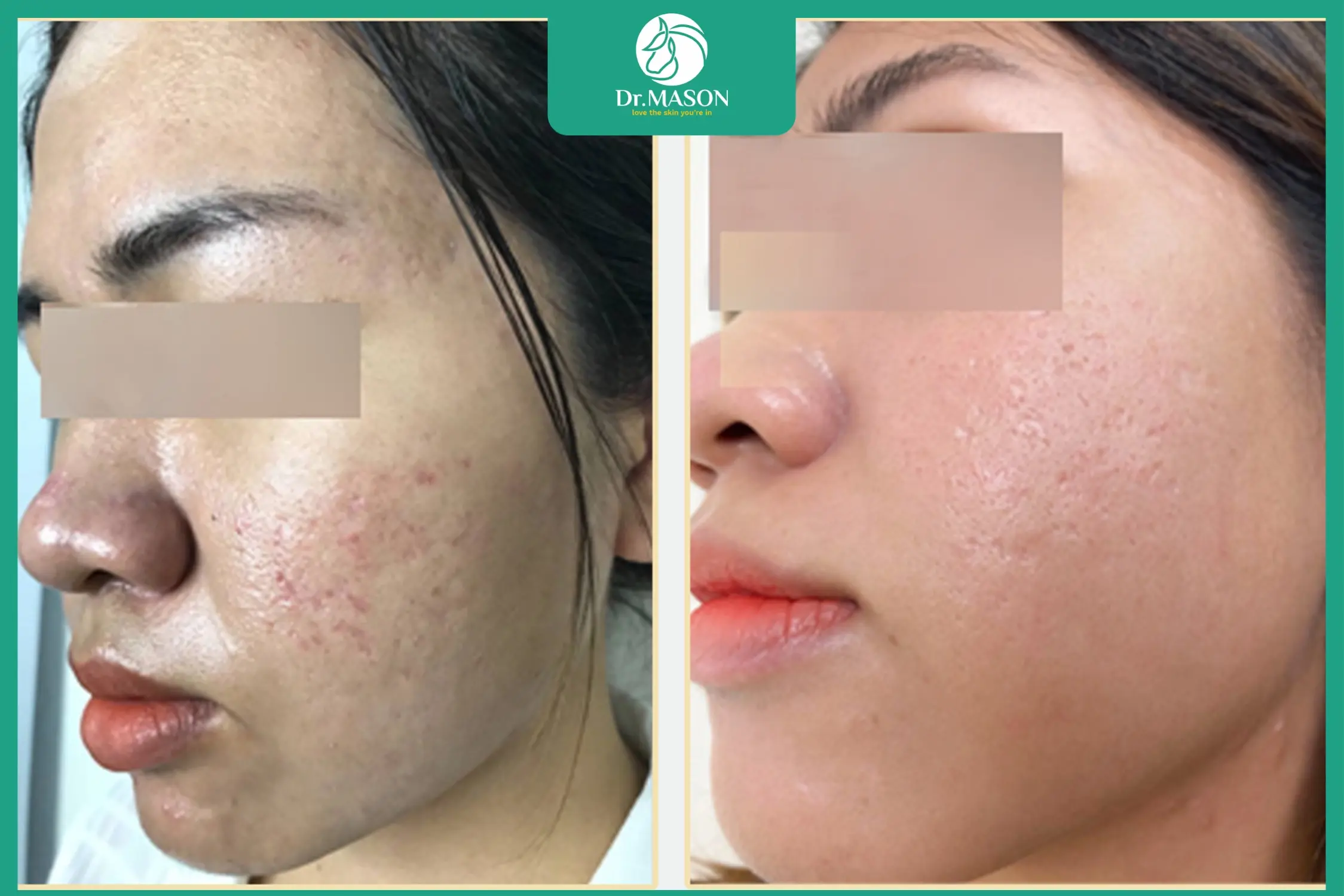 điều trị sẹo rỗ trên mặt