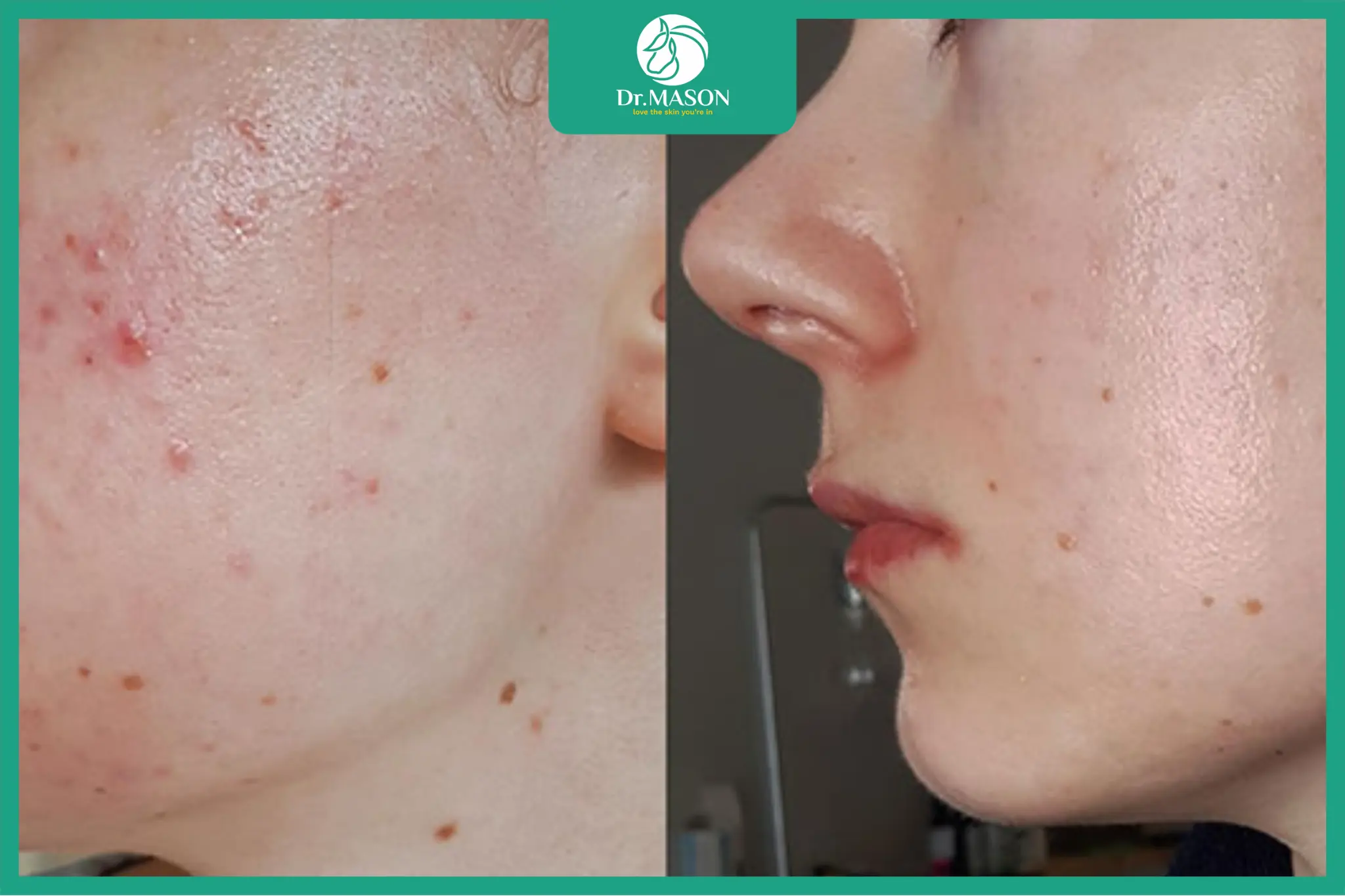 cận cảnh review điều trị mụn trước sau của isotretinoin và tretinoin